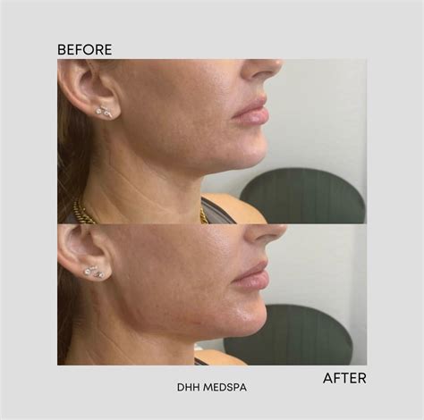 radiesse adalah|Radiesse – Bali Med Spa.